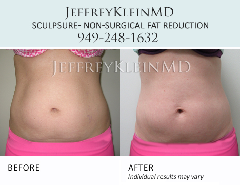 Jeffklein-sculpsure-abs-female Patient Pink