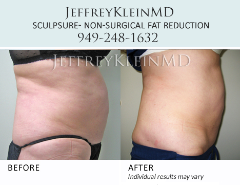 Jeffklein-sculpsure-upperabs-female-patient
