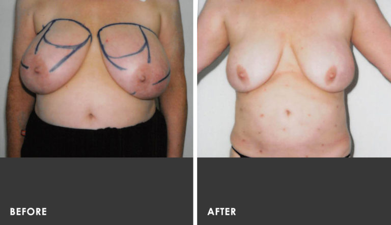 Scarless Breast Reduction