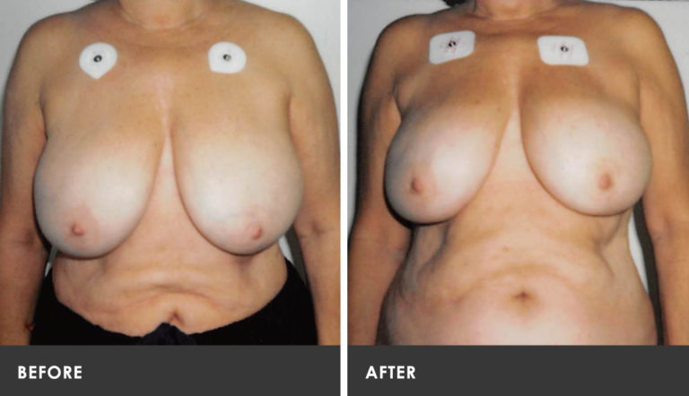 Scarless Breast Reduction