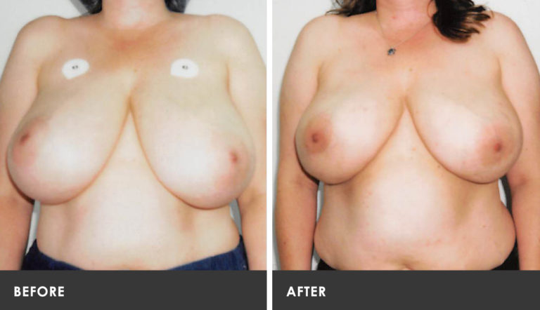 Scarless Breast Reduction