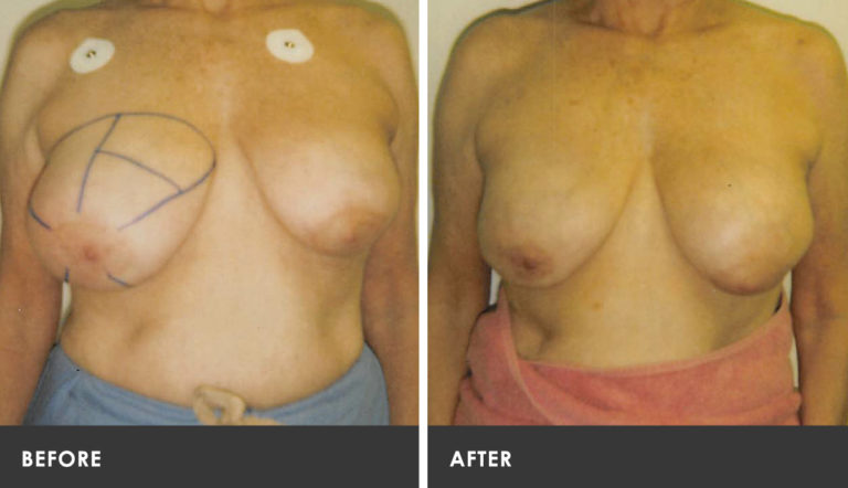 Scarless Breast Reduction