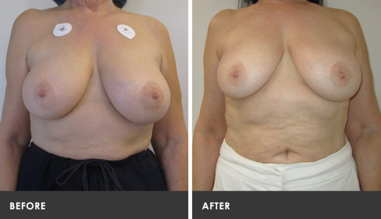 Scarless Breast Reduction