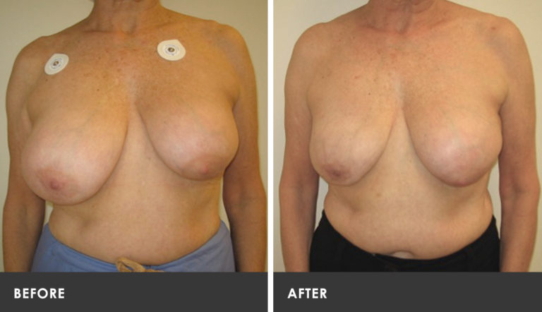 Scarless Breast Reduction