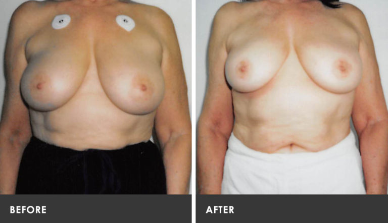 Scarless Breast Reduction