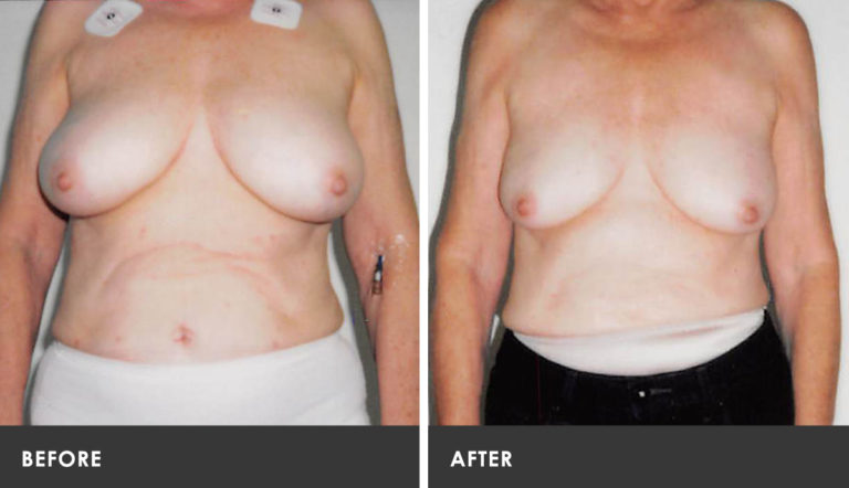 Scarless Breast Reduction