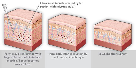 Tumescent Liposuction