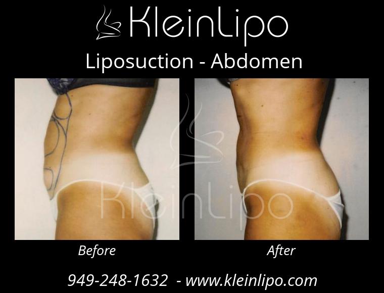 Liposuction Abdomen 2 27 2018 16 54 10