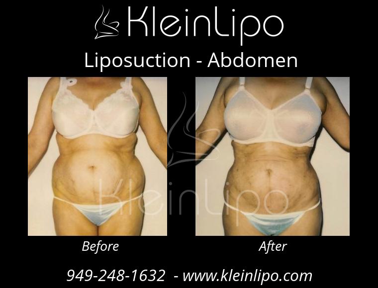 Liposuction-Abdomen-2-27-2018-16-54-14