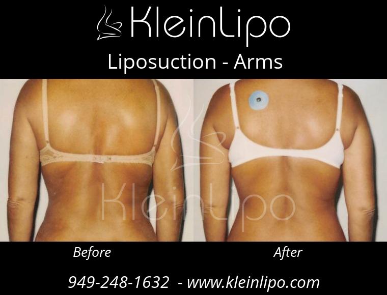 Liposuction Arms 2 27 2018 16 52 46