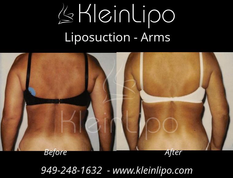 Liposuction-Arms-2-27-2018-16-52-48