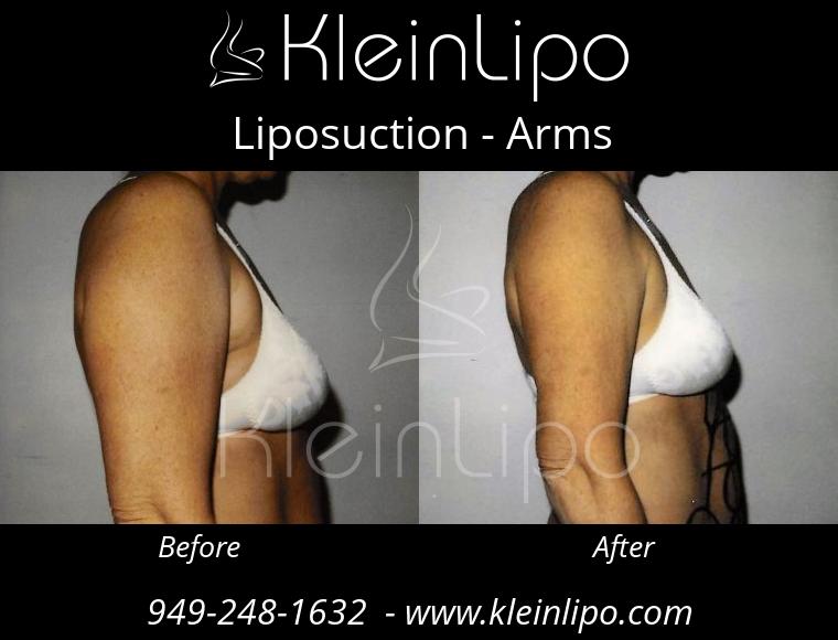 Liposuction-Arms-2-27-2018-16-52-59