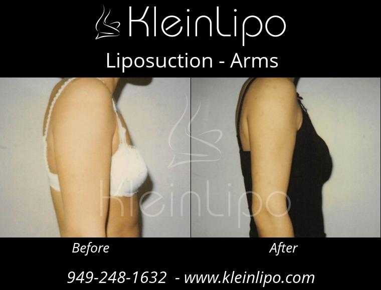 Liposuction-Arms-2-27-2018-16-53-18