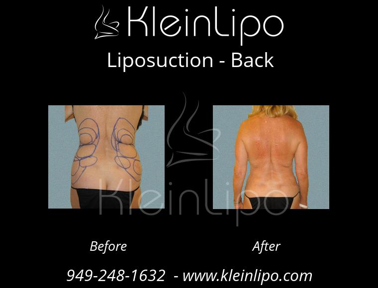 Liposuction-Back-2-27-2018-18-08-28