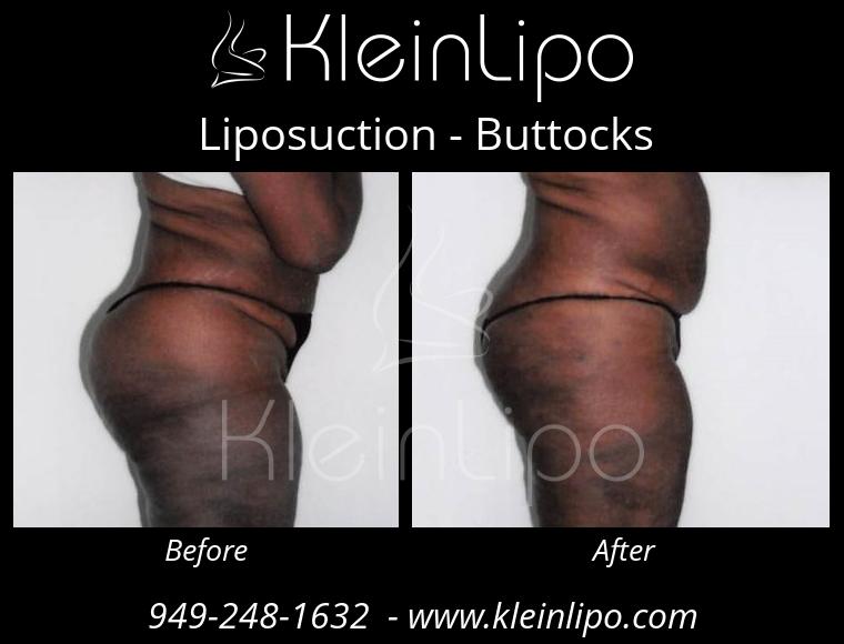 Liposuction Buttocks 2 27 2018 16 51 58