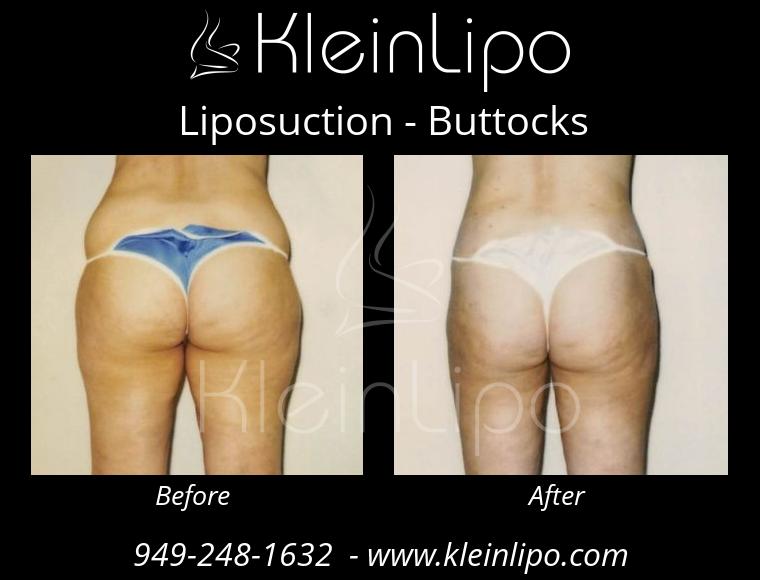 Liposuction-Buttocks-2-27-2018-16-52-03
