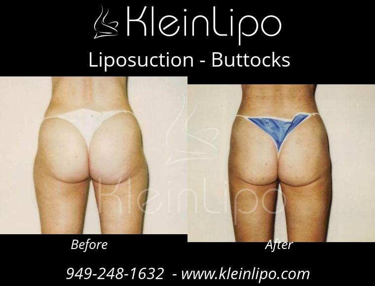 Liposuction-Buttocks-2-27-2018-16-52-05