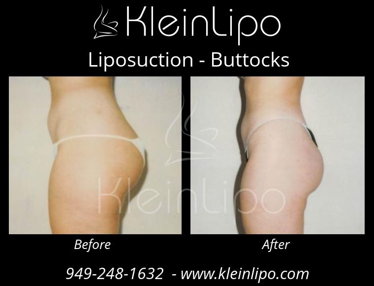 Liposuction-Buttocks-2-27-2018-16-52-09