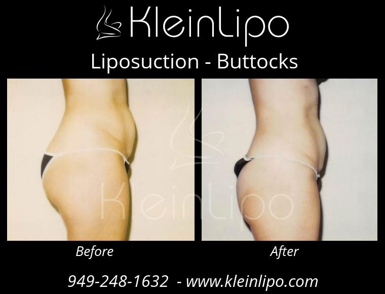 Liposuction-Buttocks-2-27-2018-16-52-16
