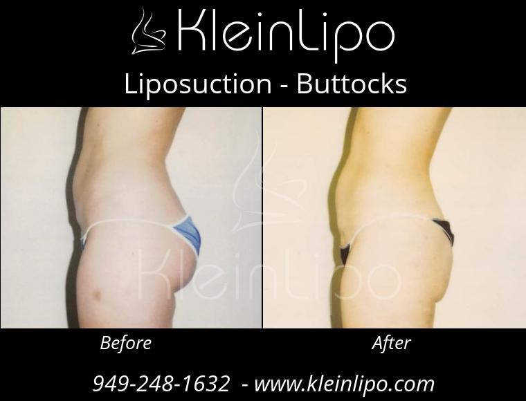Liposuction-Buttocks-2-27-2018-16-52-21