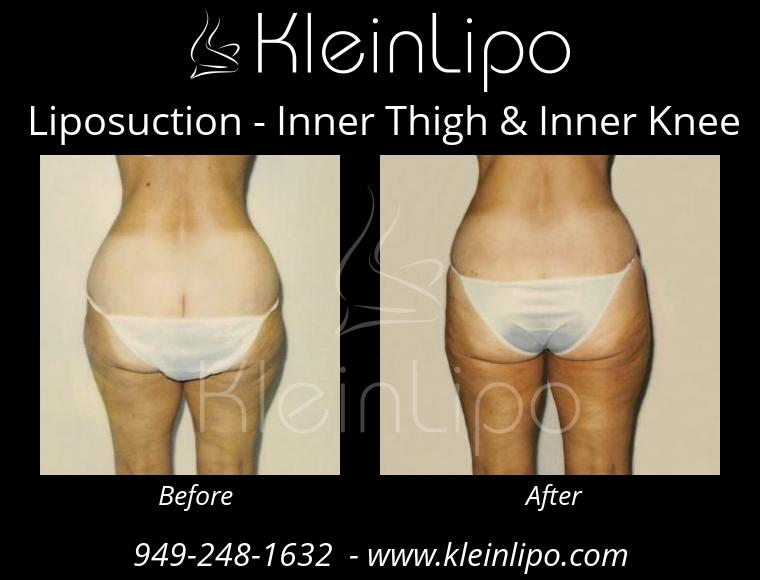 Liposuction-InnerThigh&InnerKnee-2-27-2018-16-41-54