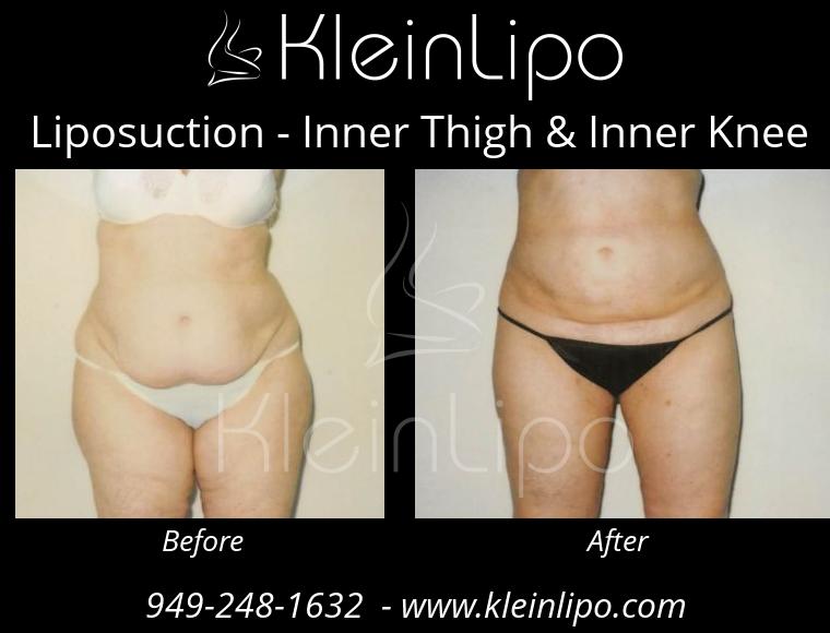 Liposuction-InnerThigh&InnerKnee-2-27-2018-16-41-58