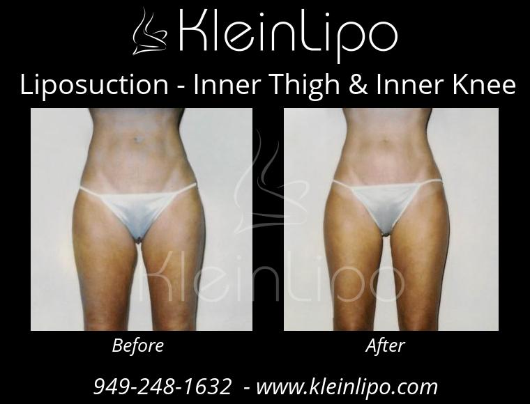 Liposuction-InnerThigh&InnerKnee-2-27-2018-16-42-01