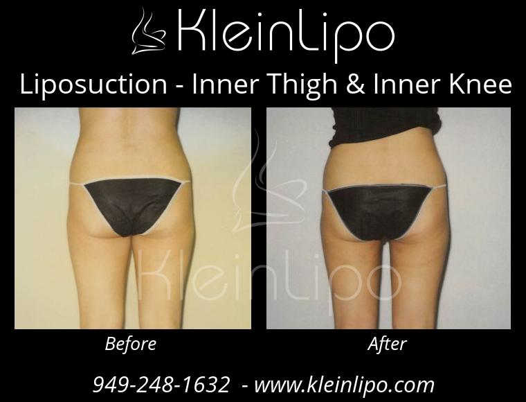 Liposuction-InnerThigh&InnerKnee-2-27-2018-16-42-18