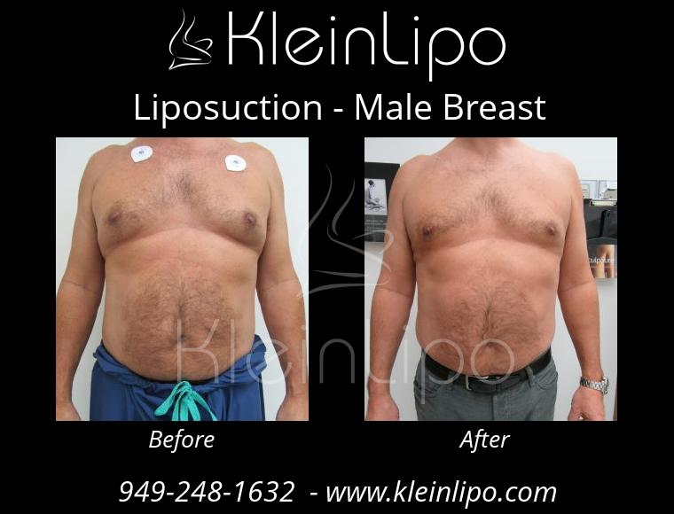 Liposuction-MaleBreast-2-27-2018-17-53-18
