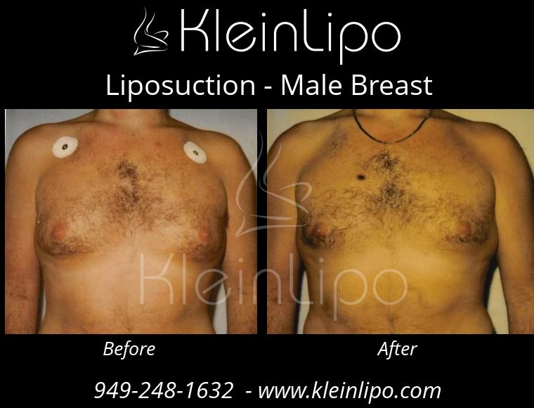 Liposuction-MaleBreast-2-27-2018-17-53-21
