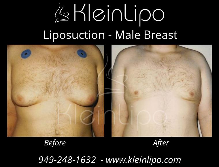 Liposuction-MaleBreast-2-27-2018-17-53-23