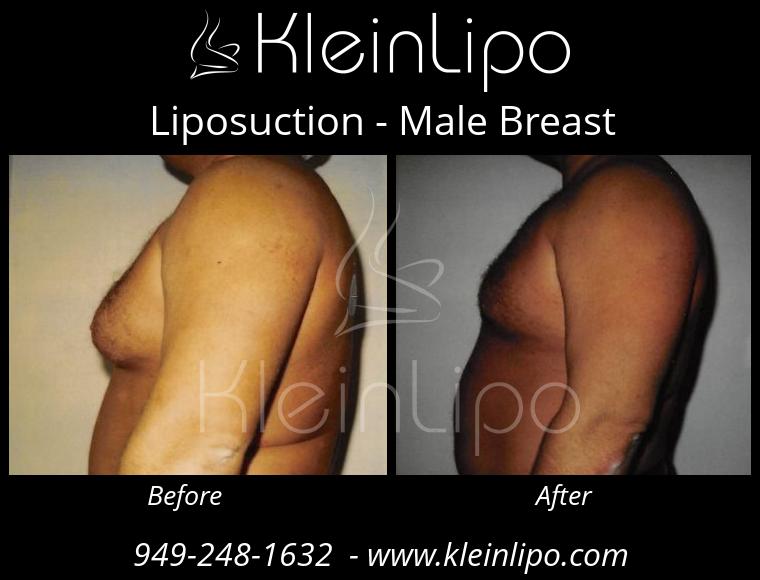 Liposuction-MaleBreast-2-27-2018-18-41-26