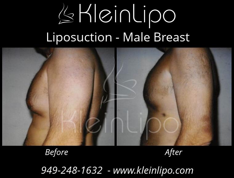 Liposuction-MaleBreast-2-27-2018-18-41-30