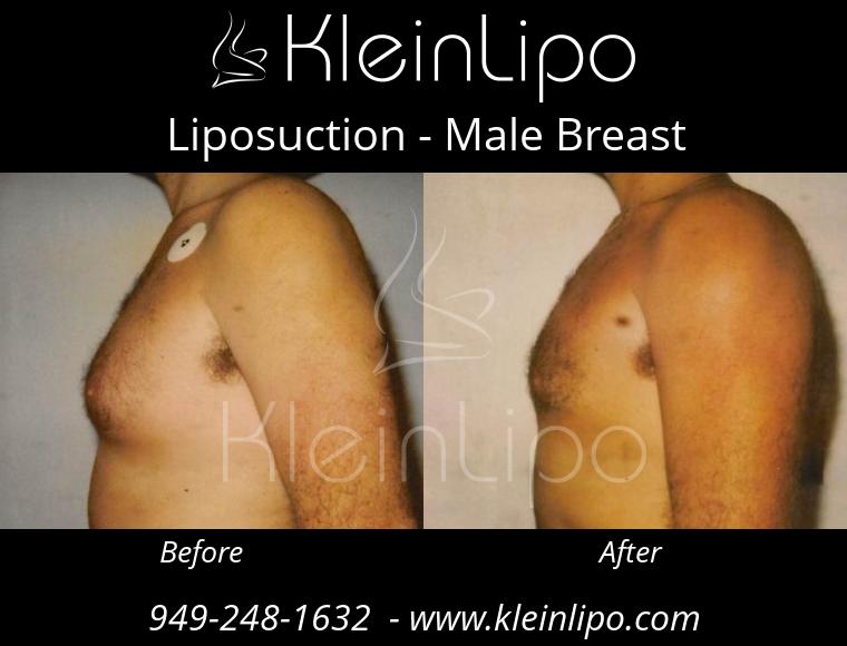 Liposuction-MaleBreast-2-27-2018-18-41-31