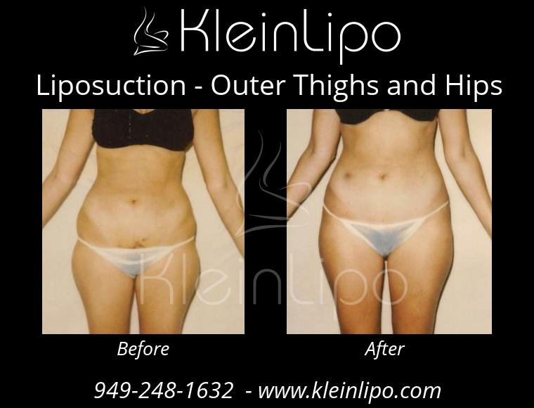 Liposuction-OuterThighsandHips-2-27-2018-16-44-36
