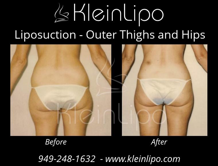 Liposuction-OuterThighsandHips-2-27-2018-16-44-44