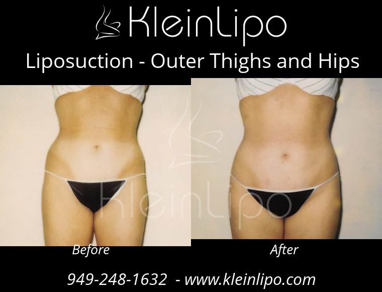 Liposuction-OuterThighsandHips-2-27-2018-16-45-29
