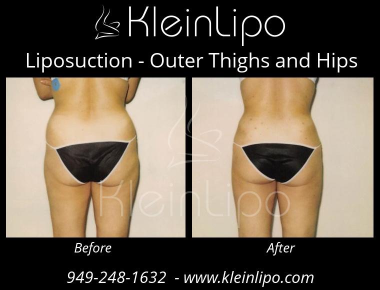 Liposuction-OuterThighsandHips-2-27-2018-16-45-30