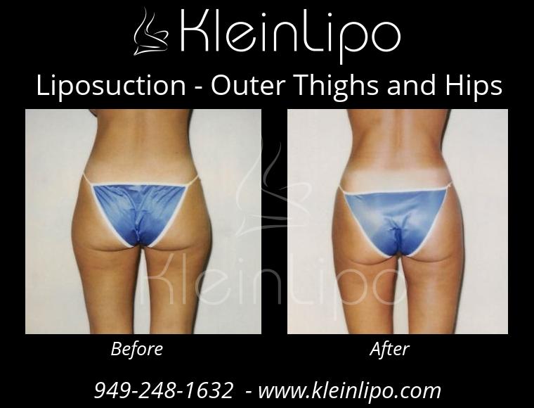 Liposuction-OuterThighsandHips-2-27-2018-16-45-35